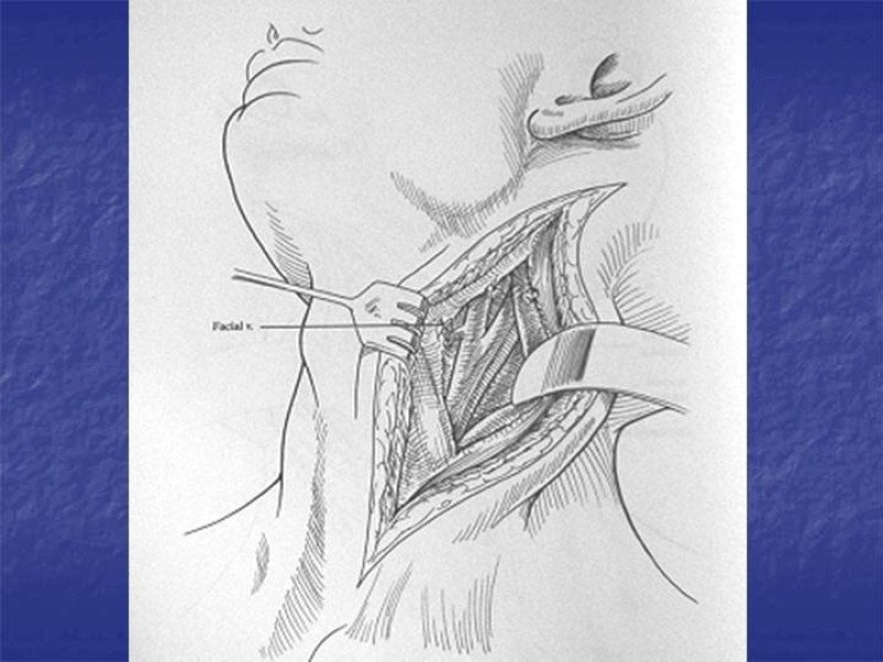Diapositiva 29 de Abordaje Quirúrgico Vasculares