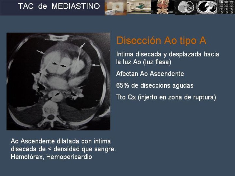 Diapositiva 27 de Imaginología Toráxica TAC