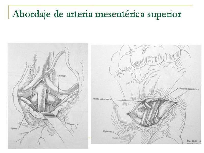 Diapositiva 66 de Accesos vasculares Abdominales