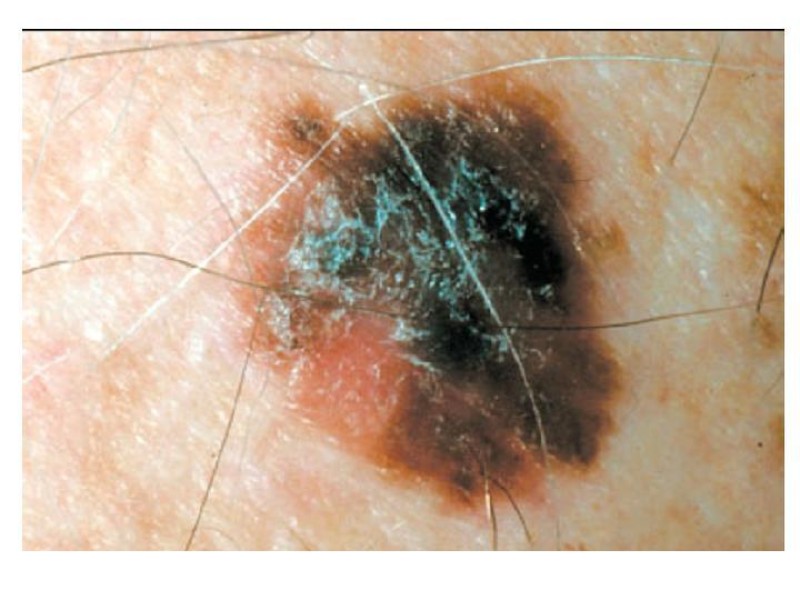 Diapositiva 24 de Melanoma