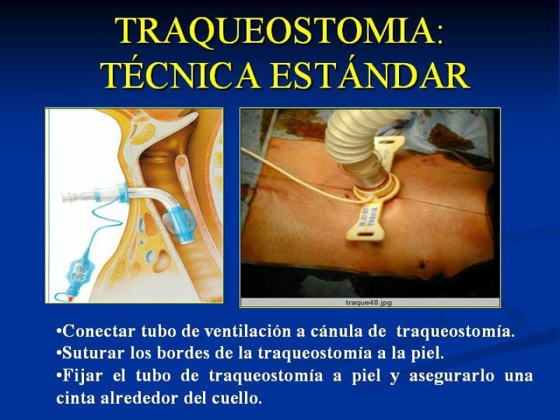 Diapositiva 16 de Traqueostomía Final