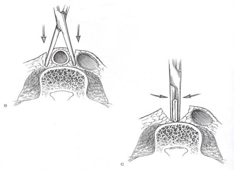 Diapositiva 16 de Accesos vasculares Abdominales