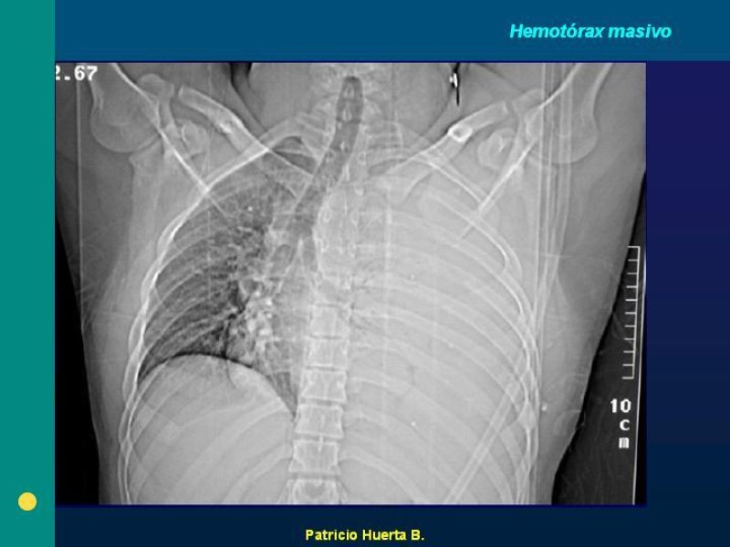 Diapositiva 6 de Hemotórax Masivo