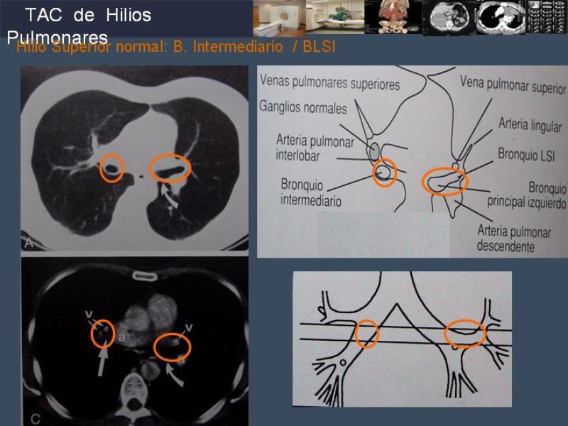 Diapositiva 51 de Imaginología Toráxica TAC