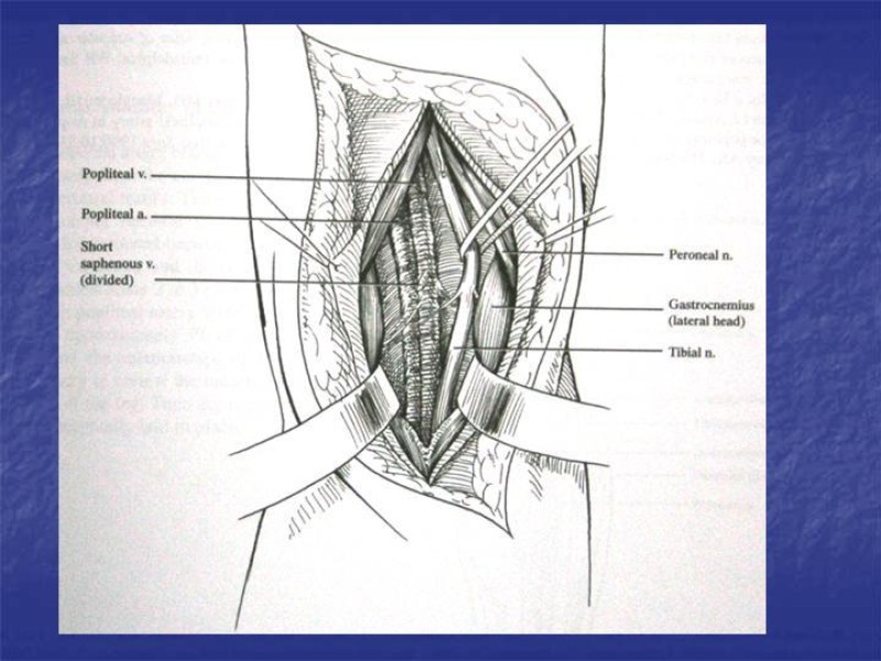 Diapositiva 105 de Abordaje Quirúrgico Vasculares