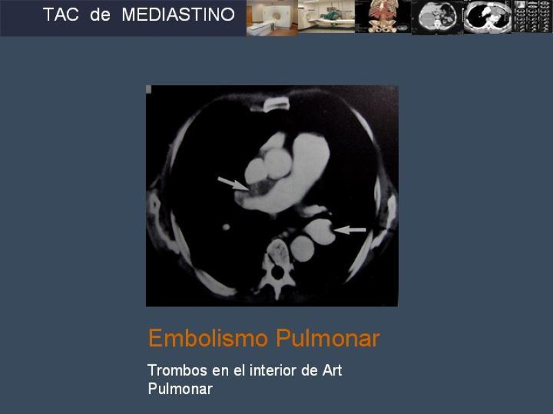 Diapositiva 30 de Imaginología Toráxica TAC