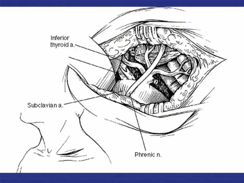 Diapositiva 42 de Abordaje Quirúrgico Vasculares
