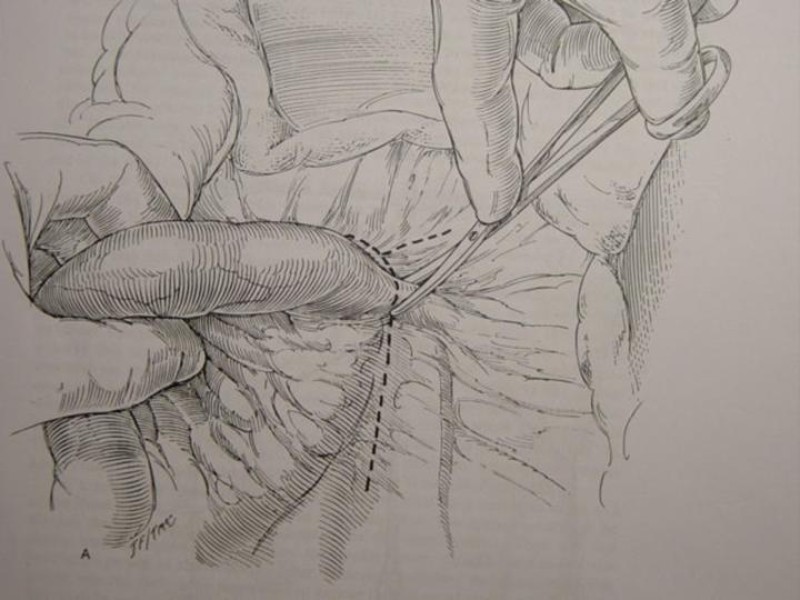 Diapositiva 69 de Accesos vasculares Abdominales