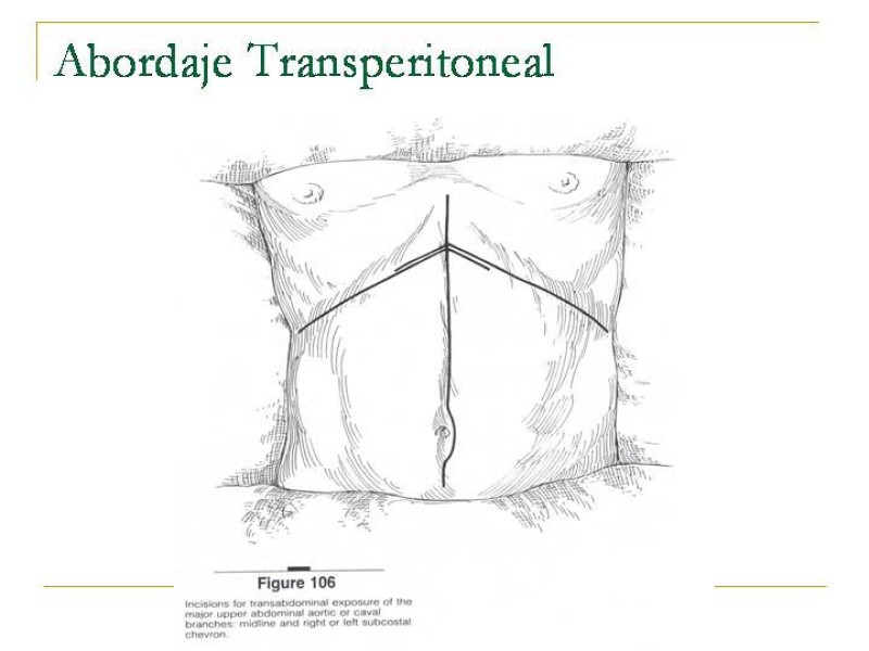 Diapositiva 11 de Accesos vasculares Abdominales