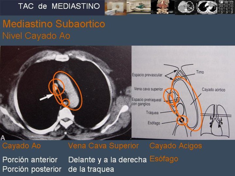 Diapositiva 12 de Imaginología Toráxica TAC