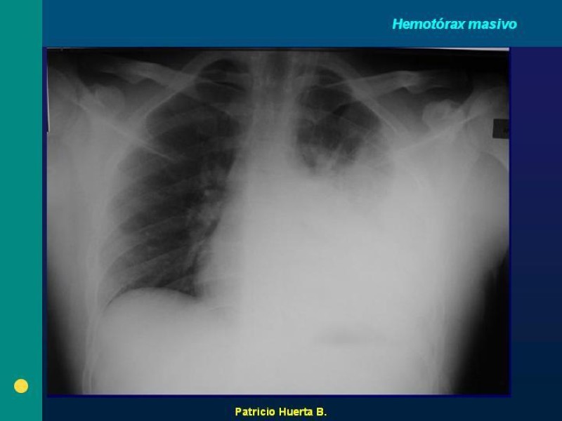 Diapositiva 5 de Hemotórax Masivo