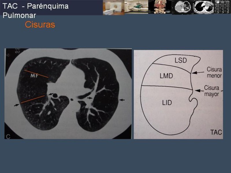 Diapositiva 58 de Imaginología Toráxica TAC