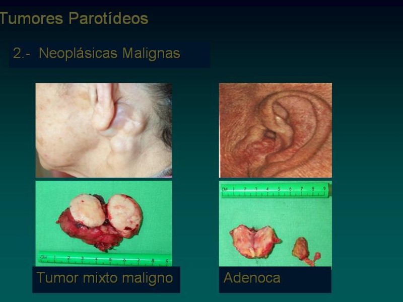 Diapositiva 11 de Masas Parotídeas