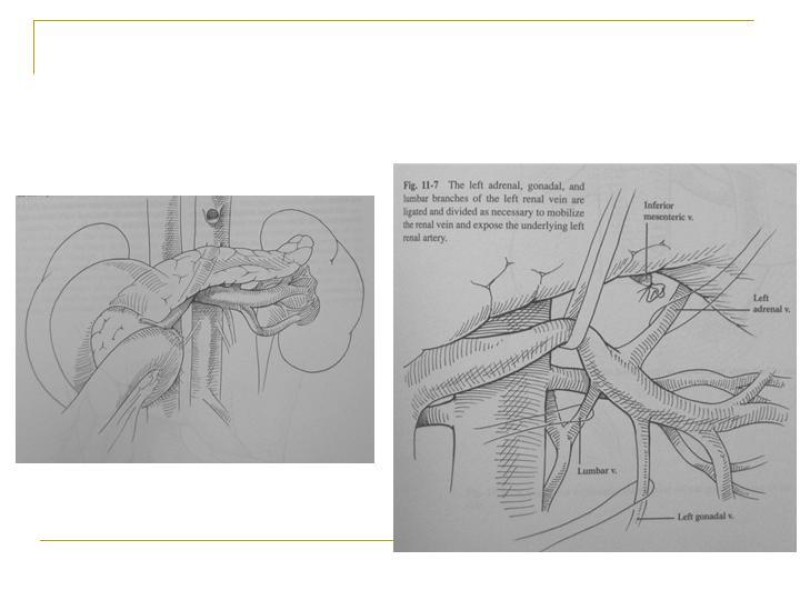 Diapositiva 85 de Accesos vasculares Abdominales