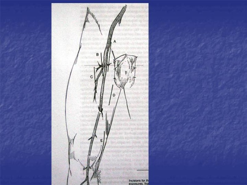 Diapositiva 89 de Abordaje Quirúrgico Vasculares