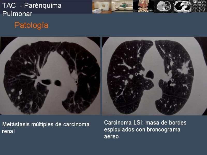 Diapositiva 59 de Imaginología Toráxica TAC