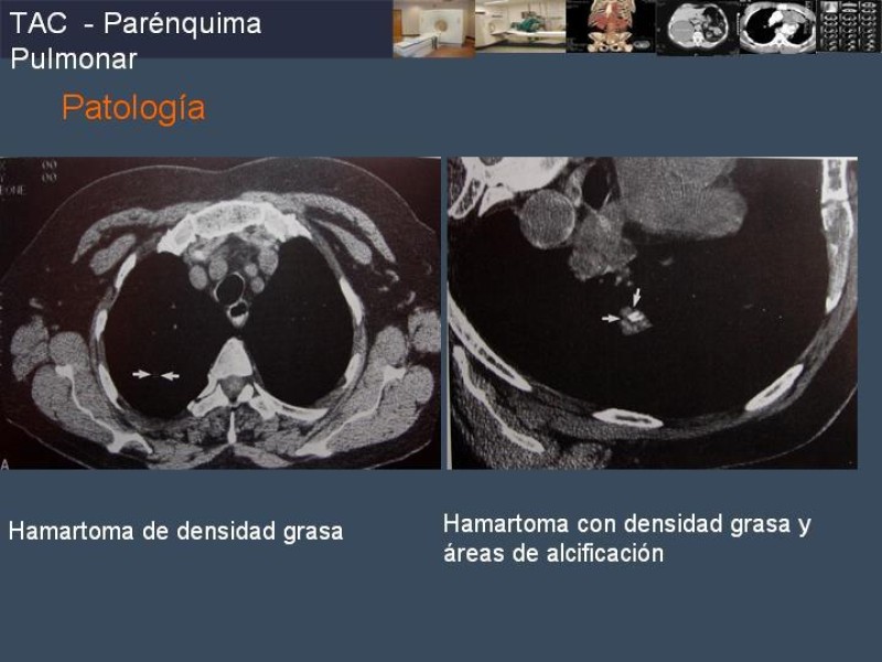 Diapositiva 61 de Imaginología Toráxica TAC