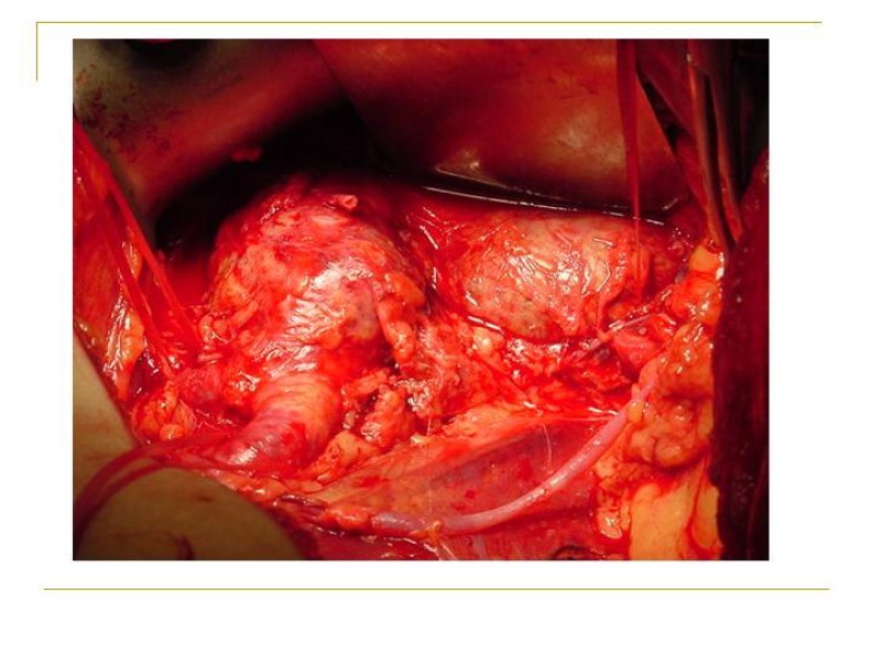 Diapositiva 41 de Accesos vasculares Abdominales