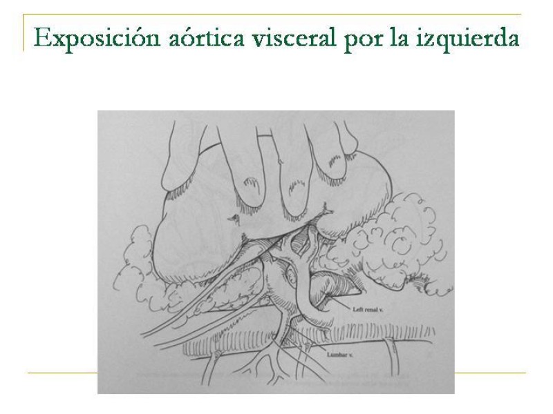 Diapositiva 30 de Accesos vasculares Abdominales