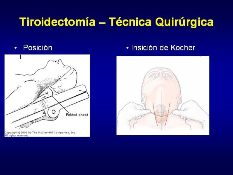 Diapositiva 14 de Tiroidectomía