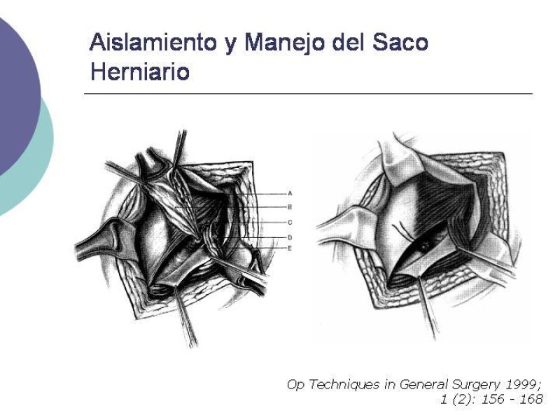 Diapositiva 8 de Hernia Inguinal: Técnica de Lichtenstein