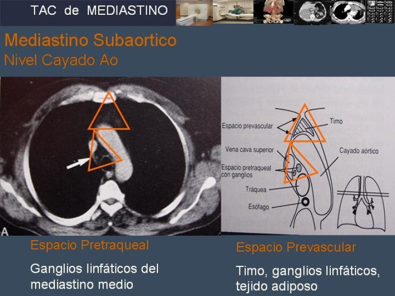 Diapositiva 13 de Imaginología Toráxica TAC