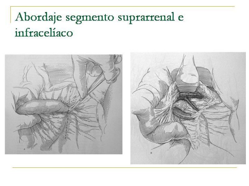 Diapositiva 18 de Accesos vasculares Abdominales