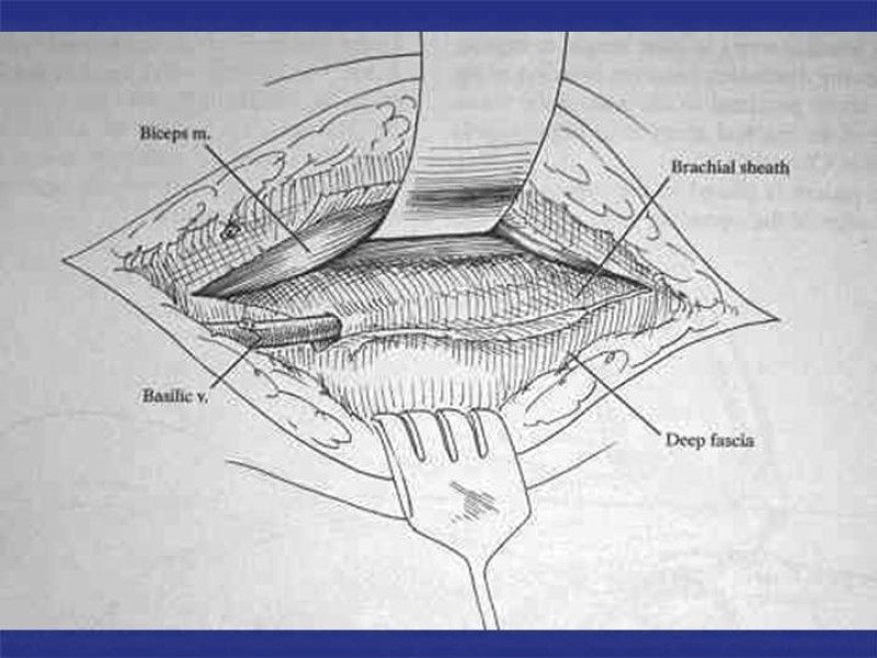 Diapositiva 67 de Abordaje Quirúrgico Vasculares