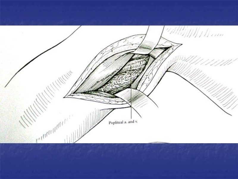 Diapositiva 112 de Abordaje Quirúrgico Vasculares