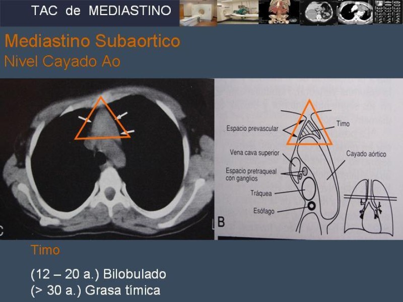 Diapositiva 14 de Imaginología Toráxica TAC