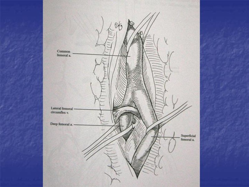 Diapositiva 92 de Abordaje Quirúrgico Vasculares