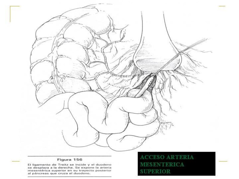 Diapositiva 78 de Accesos vasculares Abdominales