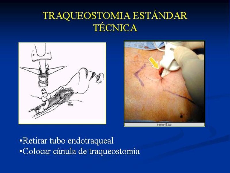 Diapositiva 15 de Traqueostomía Final