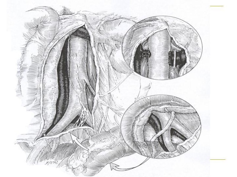 Diapositiva 22 de Accesos vasculares Abdominales
