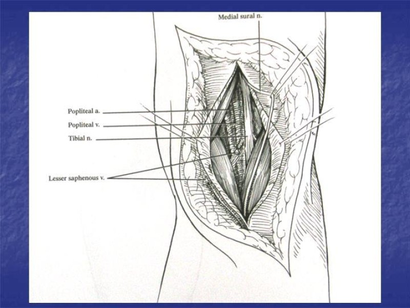 Diapositiva 104 de Abordaje Quirúrgico Vasculares