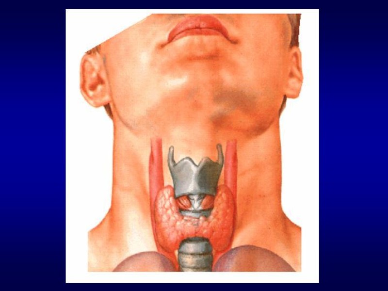 Diapositiva 5 de Tiroidectomía