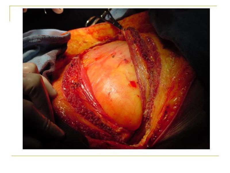 Diapositiva 40 de Accesos vasculares Abdominales