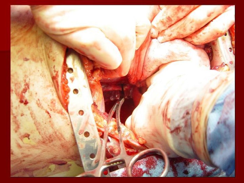 Diapositiva 26 de Toracotomía de Urgencia