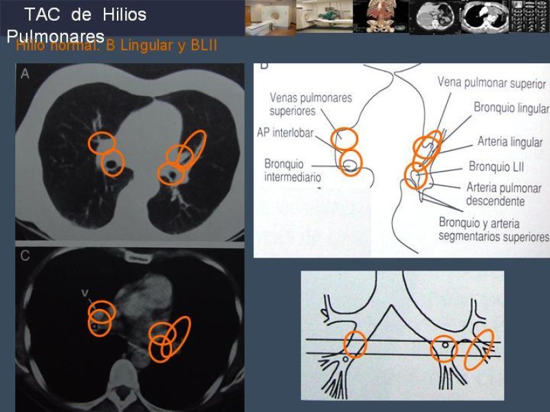 Diapositiva 53 de Imaginología Toráxica TAC