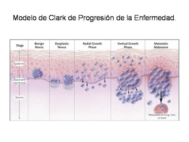 Diapositiva 14 de Melanoma