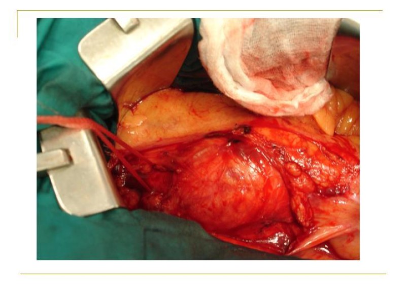 Diapositiva 23 de Accesos vasculares Abdominales
