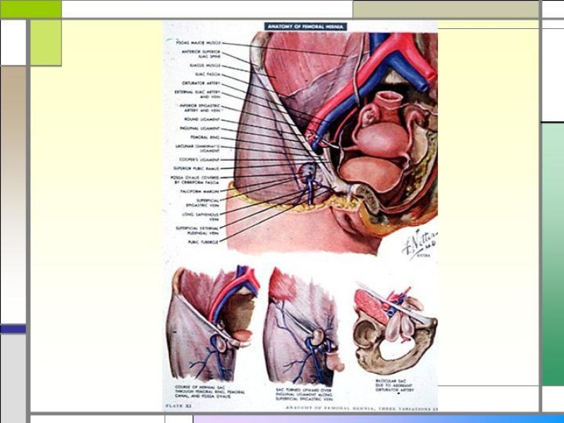 Diapositiva 4 de Tratamiento de la Hernia Femoral