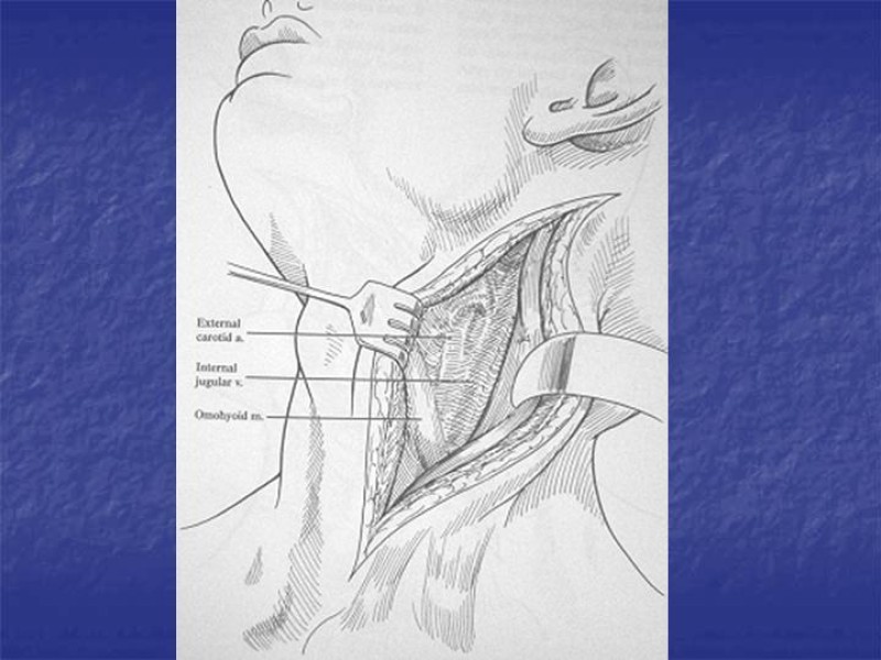 Diapositiva 27 de Abordaje Quirúrgico Vasculares