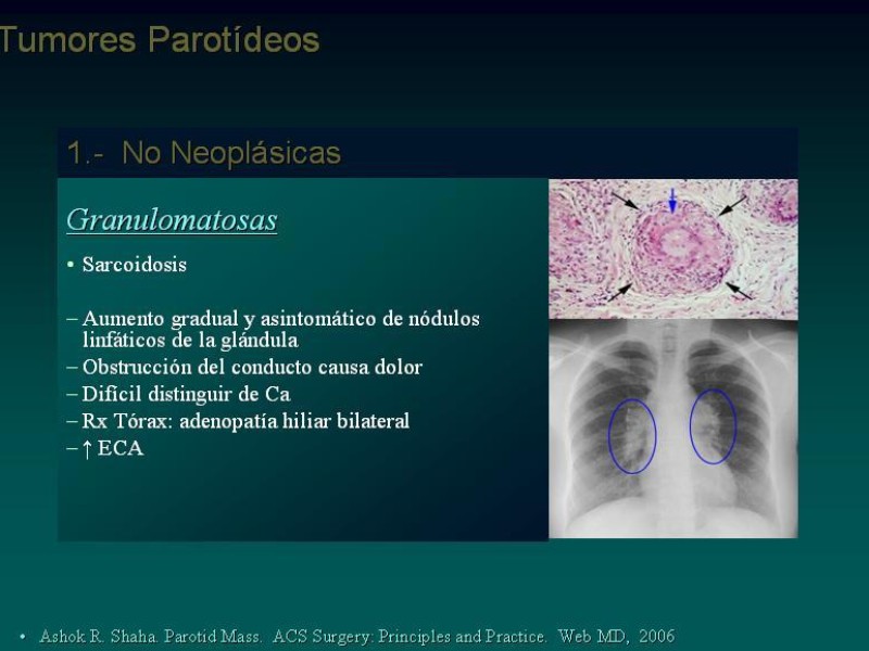 Diapositiva 5 de Masas Parotídeas