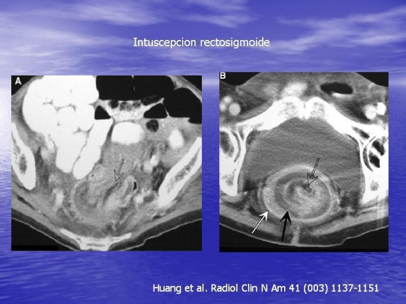 Diapositiva 24 de Obstrucción Intestinal: Estudio Diagnostico y Manejo inicial