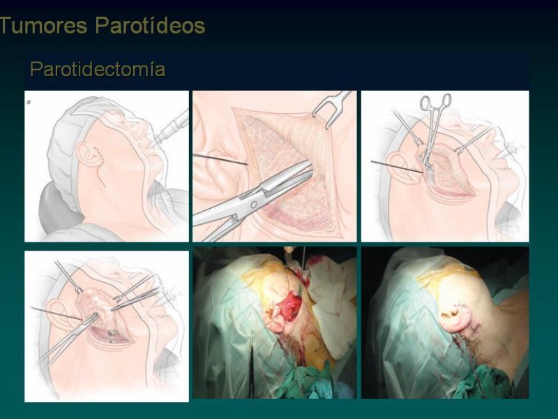 Diapositiva 22 de Masas Parotídeas