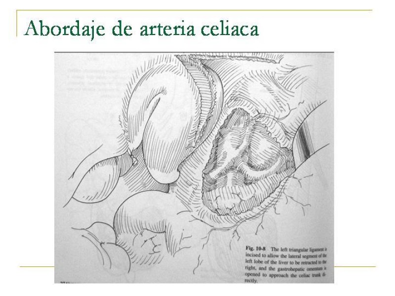 Diapositiva 63 de Accesos vasculares Abdominales