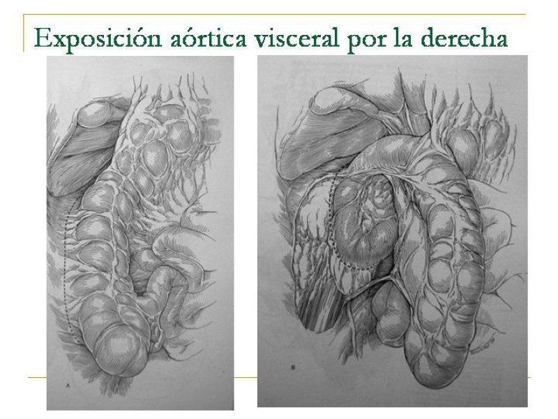 Diapositiva 33 de Accesos vasculares Abdominales