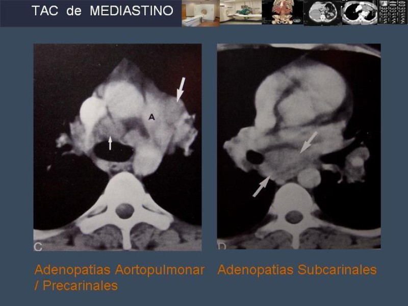 Diapositiva 35 de Imaginología Toráxica TAC
