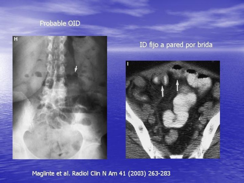 Diapositiva 11 de Obstrucción Intestinal: Estudio Diagnostico y Manejo inicial